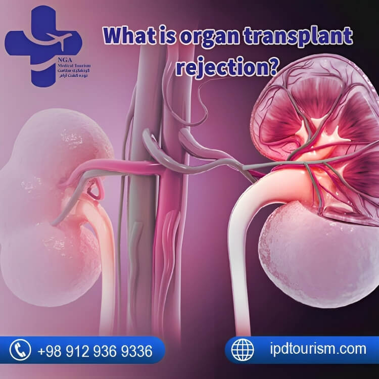 What is organ transplant rejection?