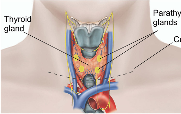 Thyroidectomy Surgery