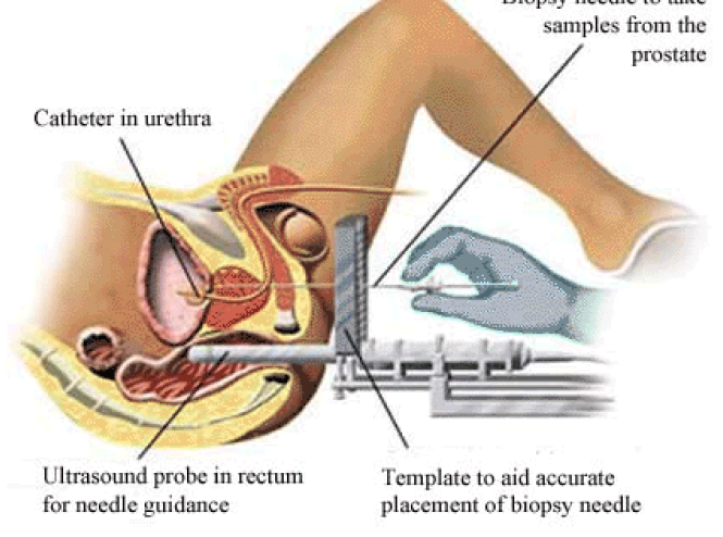 Prostatectomy in Iran | Best surgeons, results & costs