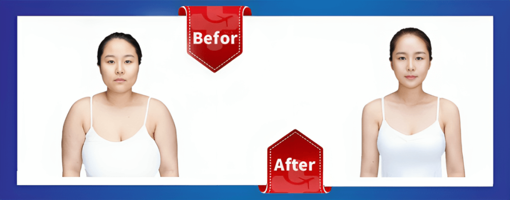 Breast Reduction surgery