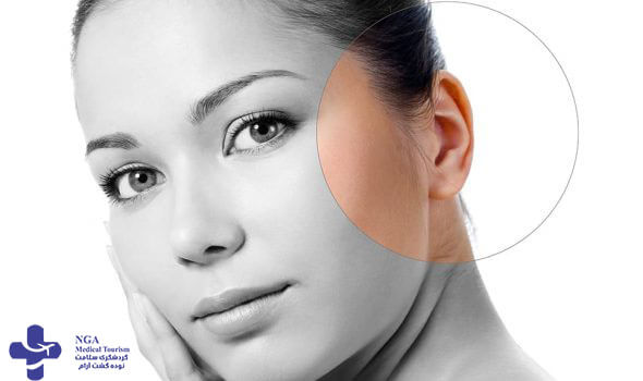 Is otoplasty painful?