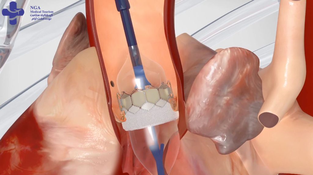 how to fix a leaky heart valve without surgery