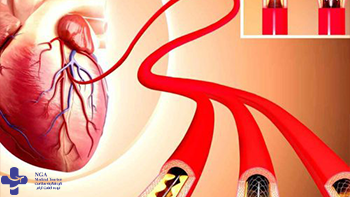 The affordable cost of heart transplant surgery in iran