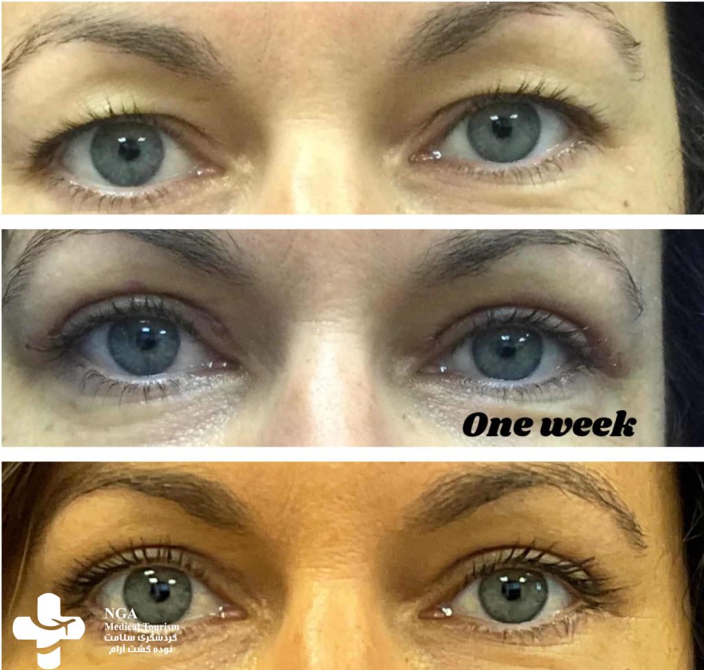 photos one week after eyelid surgery