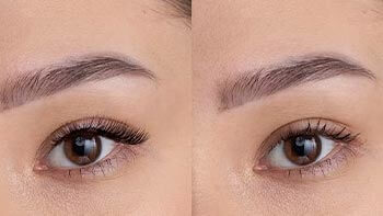 Oriental-Eyelid-Surgery
