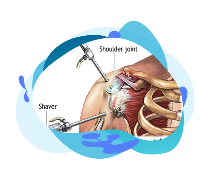 what is Shoulder-Arthroscopy