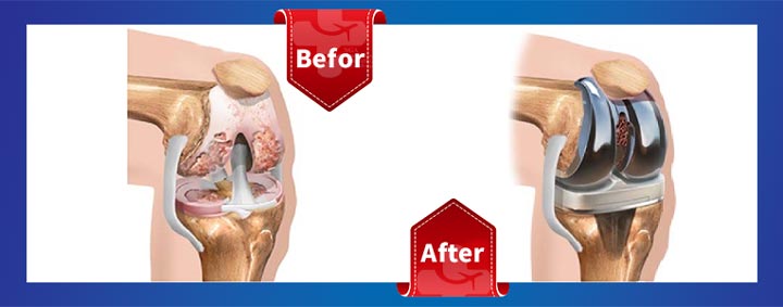befor-&-after-Orthopedic-surgery