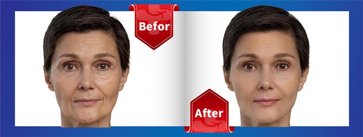 befor-&-after-non-surgical-cosmetic-procedures