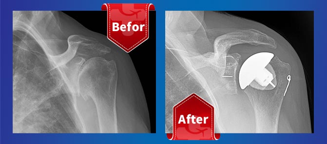 befor-&-after-shoulder-replacement