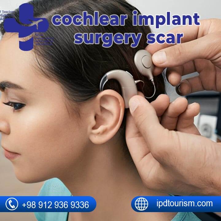 Cochlear Implant Surgery-4