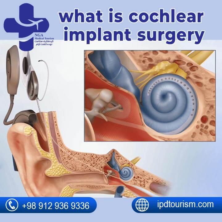 Cochlear Implant Surgery-2