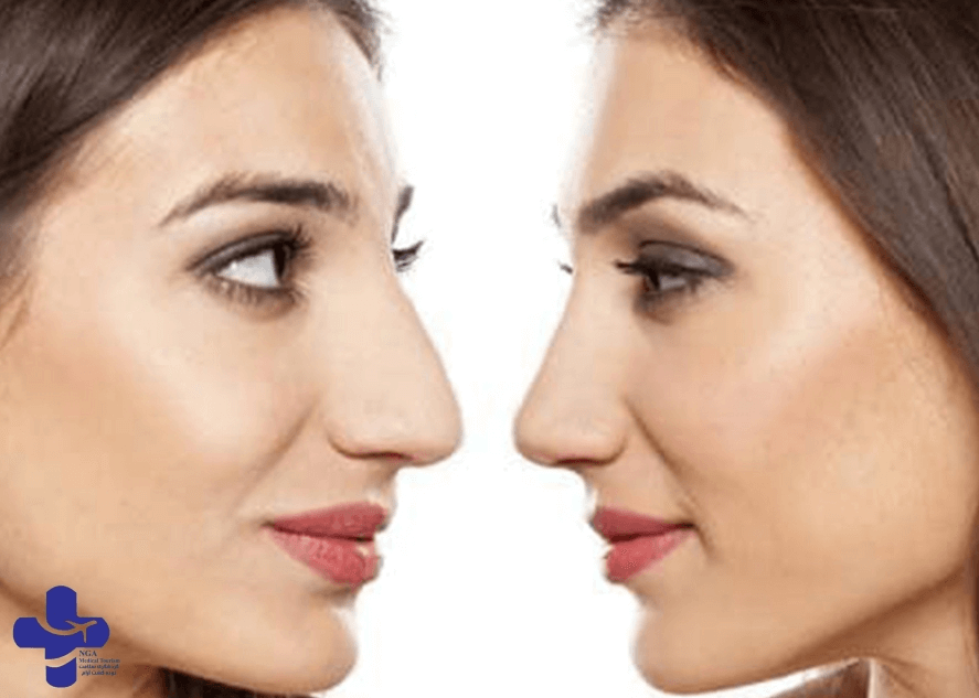 Revision Rhinoplasty Before and After2