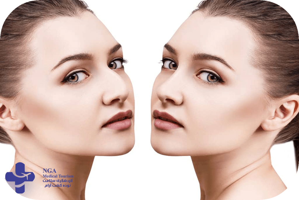 How long it take to recover after a revision rhinoplasty?
