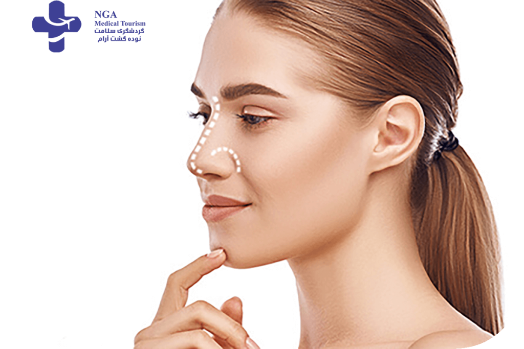 How long does it take for swelling to go down after revision rhinoplasty?