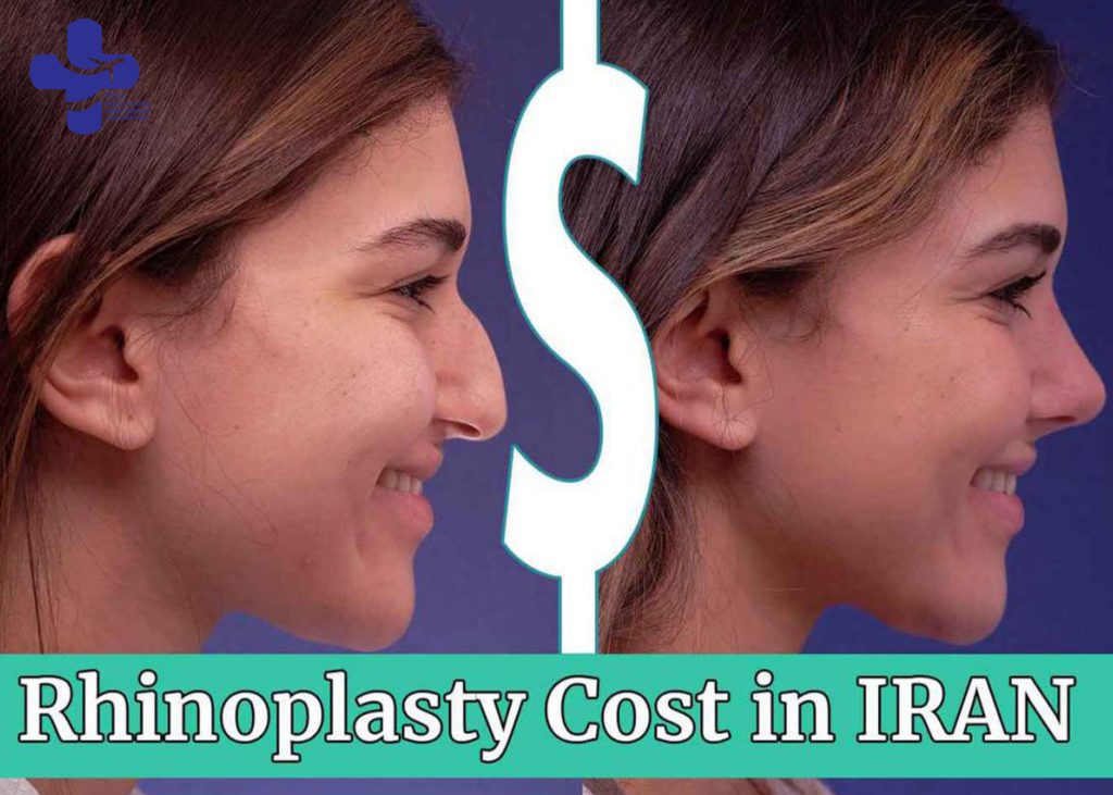 Rhinoplasty in iran|Rhinoplasty cost in iran 20223