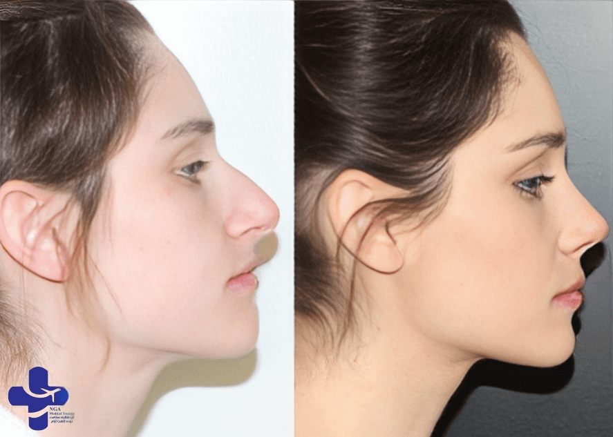 Revision Rhinoplasty Before and After 1