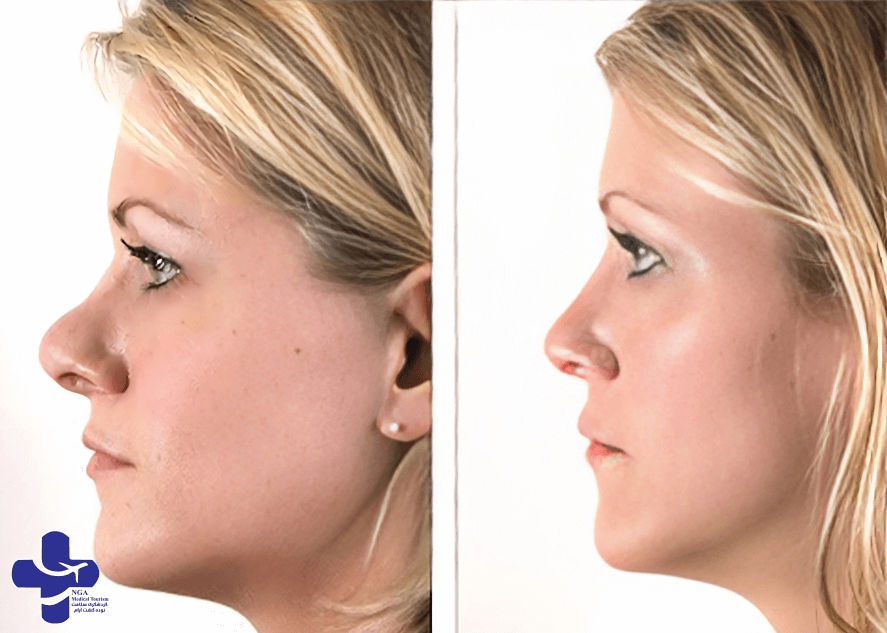 Revision Rhinoplasty Before and After