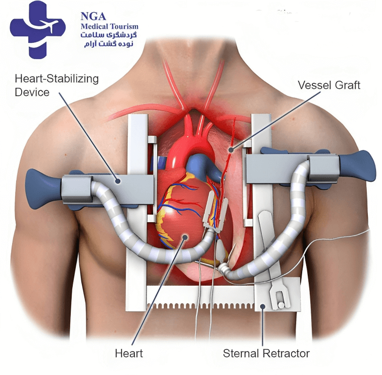 open heart surgery: