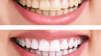 Tooth-whitening-or-tooth-bleaching in iran
