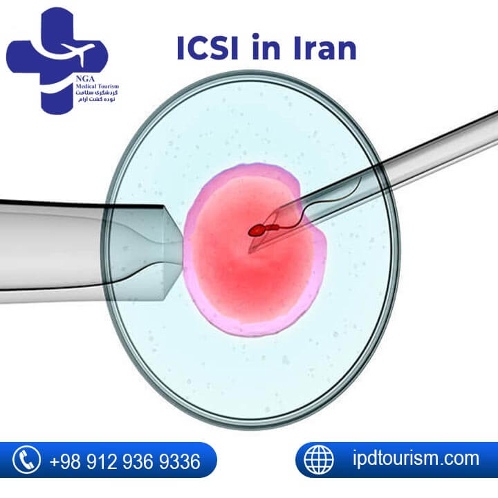 ICSI in Iran