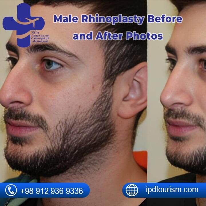 Male Rhinoplasty Before and After Photos