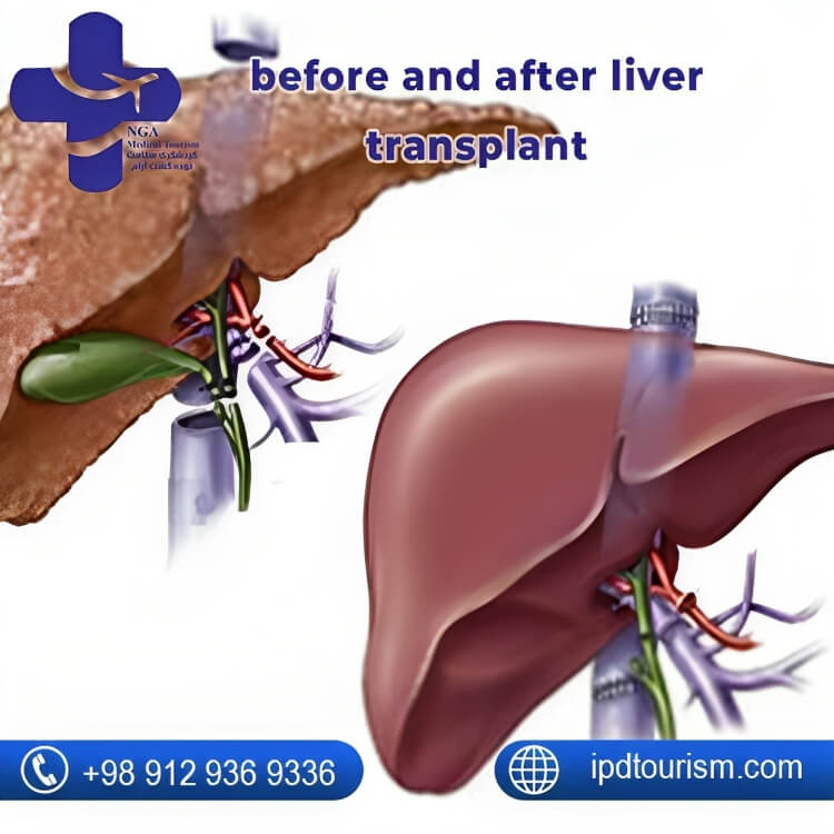 before and after liver transplant